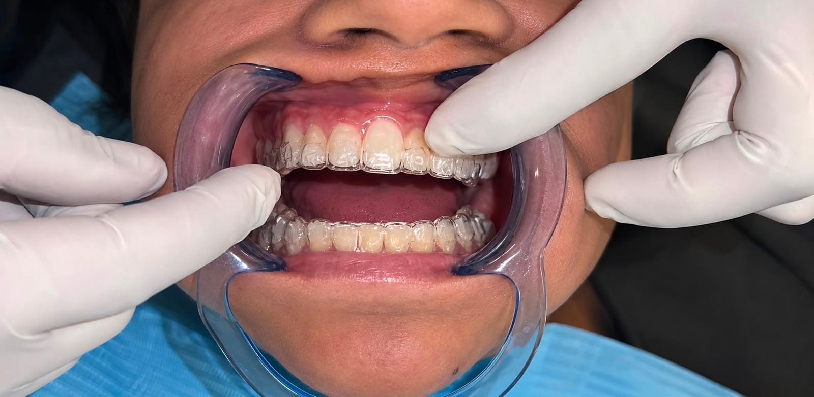 Digital dentistry at The DentalBrace Clinic Bathinda — intraoral scanner and 3D digital treatment planning by Dr. Sandeep Kumar MDS Orthodontics