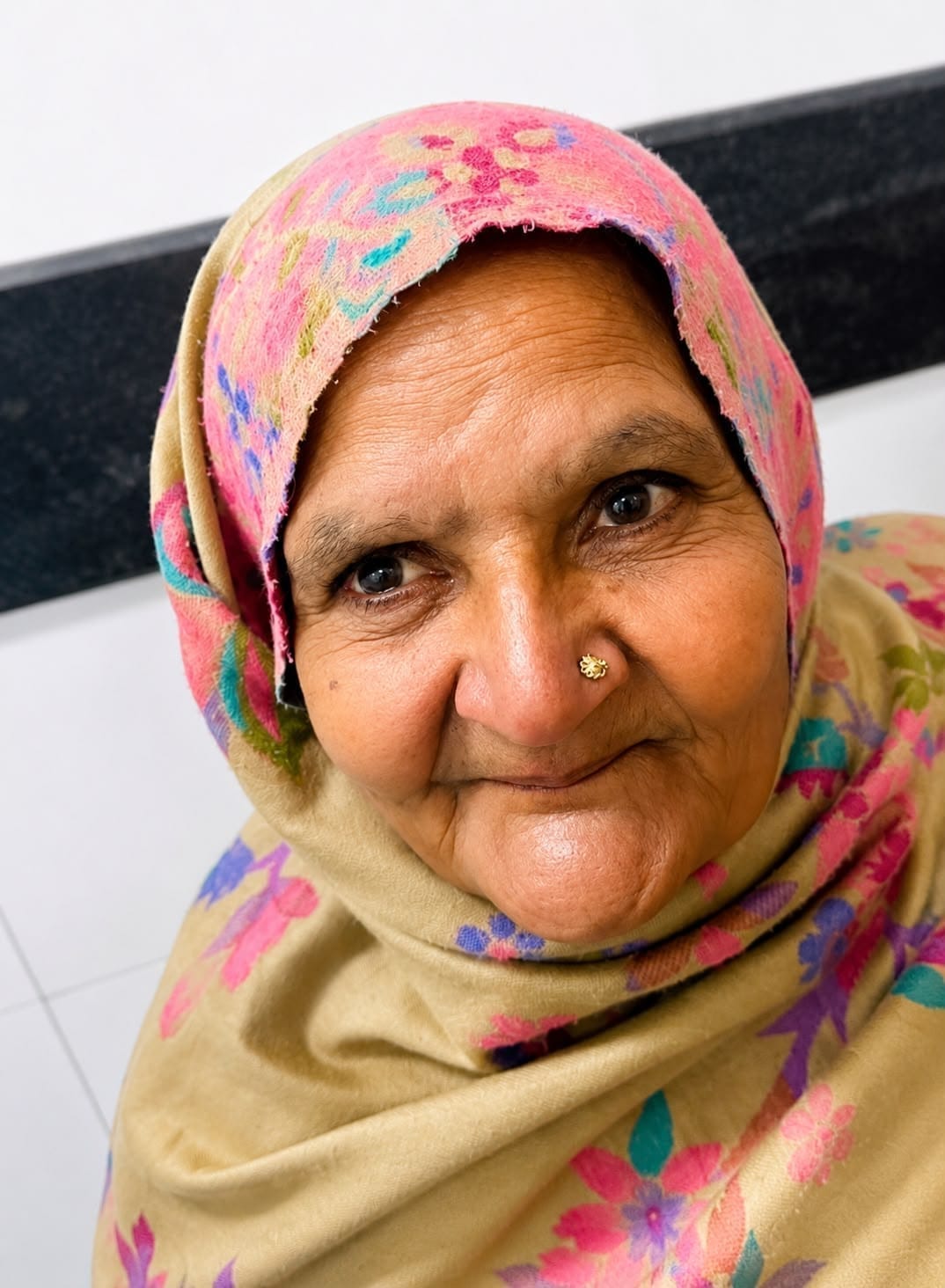 Patient after custom maxillofacial prosthesis by Dr. Ritu Saneja