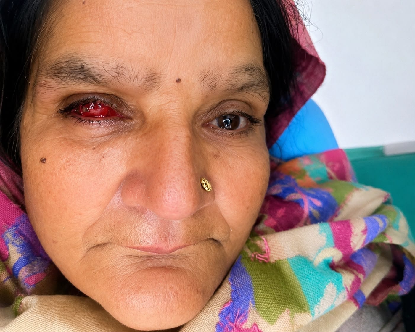 Patient before maxillofacial prosthetic treatment by Dr. Ritu Saneja