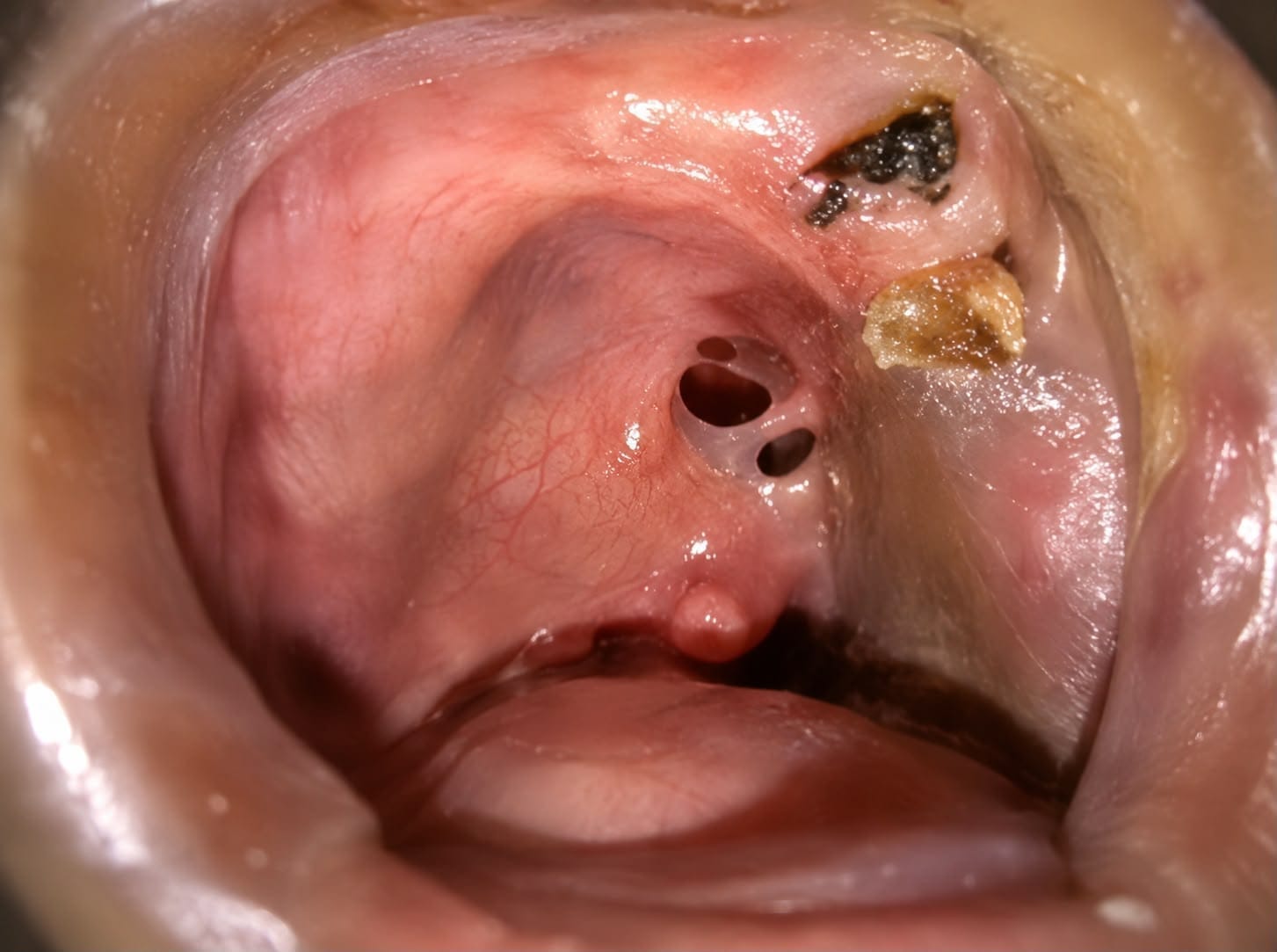 Patient before maxillofacial prosthetic treatment by Dr. Ritu Saneja