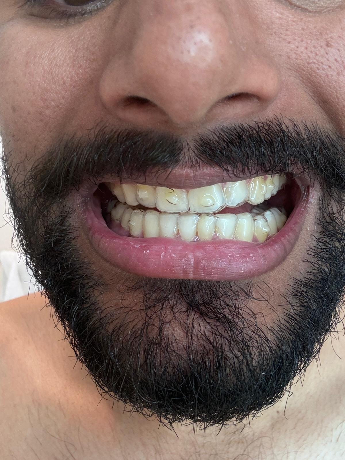 Clear aligners orthodontic treatment result at The DentalBrace Clinic Bathinda — patient Uday P. showing beautifully straight teeth after clear aligner therapy by Dr. Sandeep Kumar MDS Orthodontist, best Invisalign provider in Bathinda Punjab India