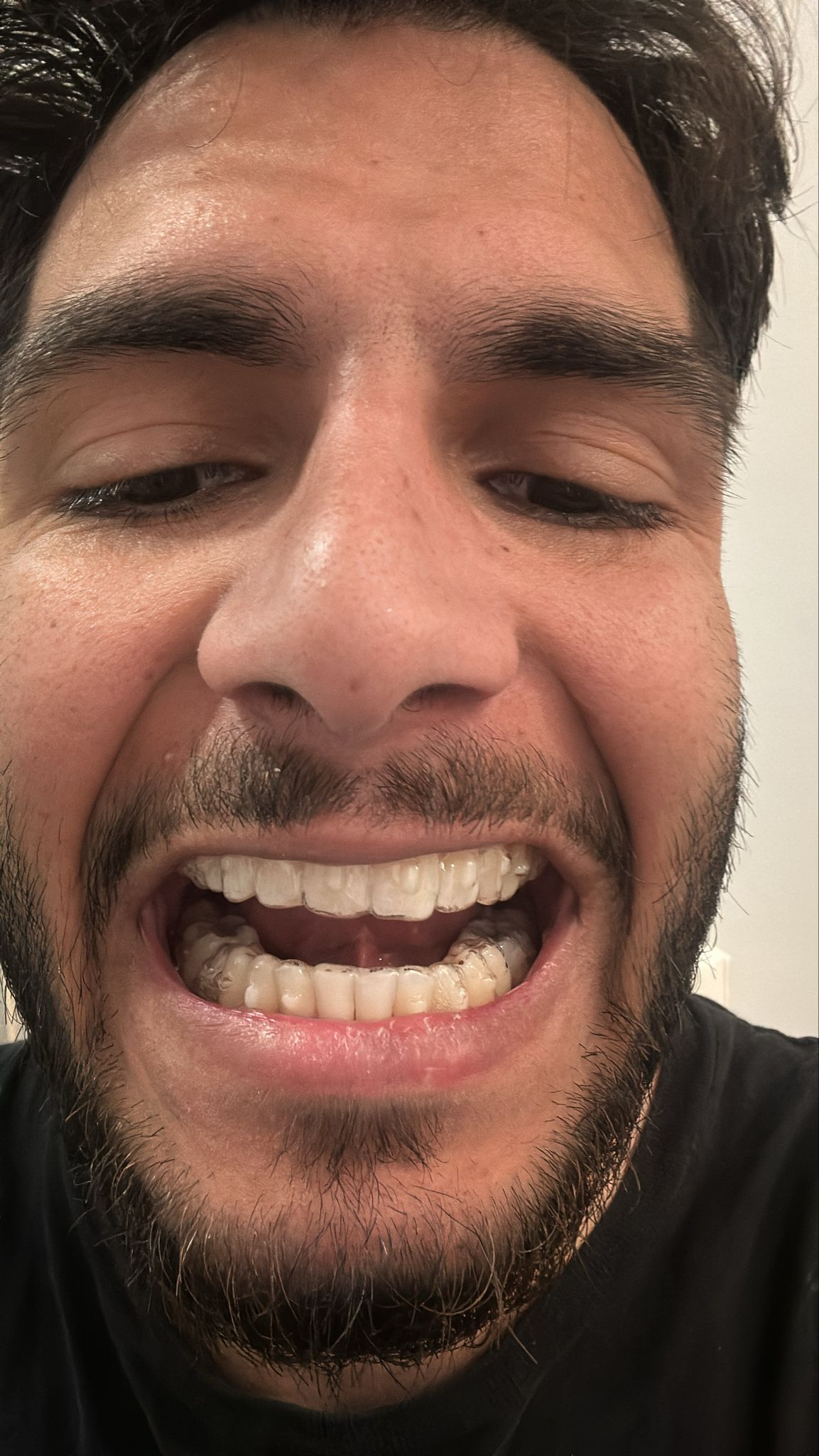 Clear aligners orthodontic treatment result at The DentalBrace Clinic Bathinda — patient Dapinder Singh from Australia showing straight teeth after clear aligner therapy by Dr. Sandeep Kumar MDS Orthodontist, best Invisalign provider in Bathinda Punjab India